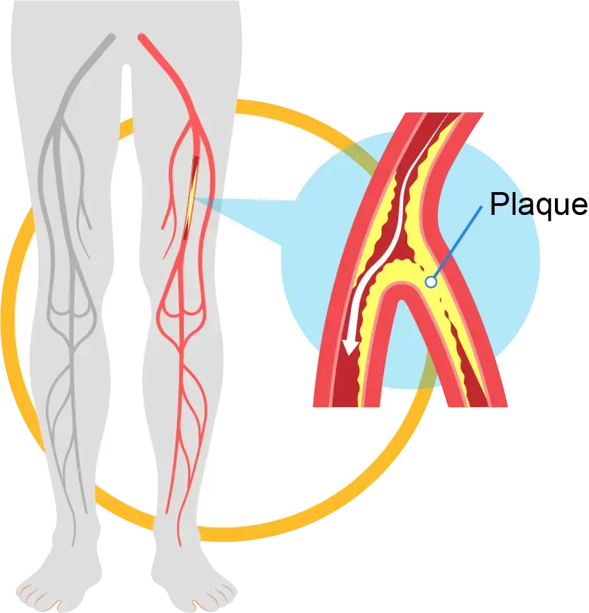 peripheral-vascular-disease