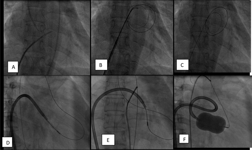 A-Transseptal-puncture-B-transseptal-dilatation-C-0025-00-stainless-steel-floppy