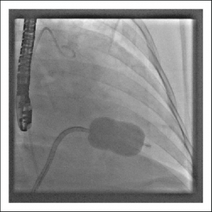 Fluoroscopy-image-of-the-PTMC-with-the-Inoue-balloon-inflated-across-the-mitral-valve