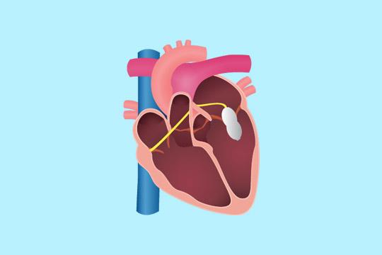 mitral-balloon