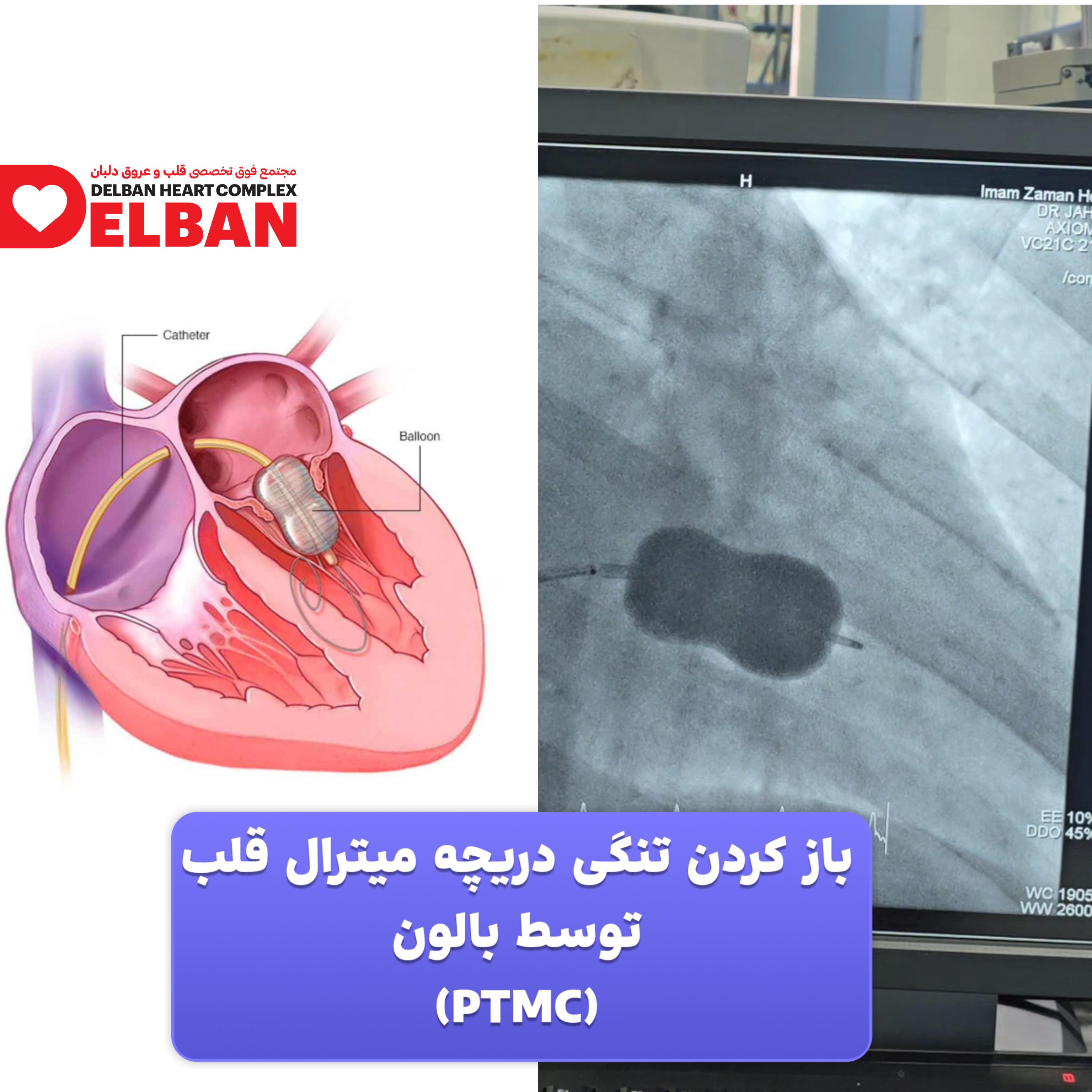 PTMC