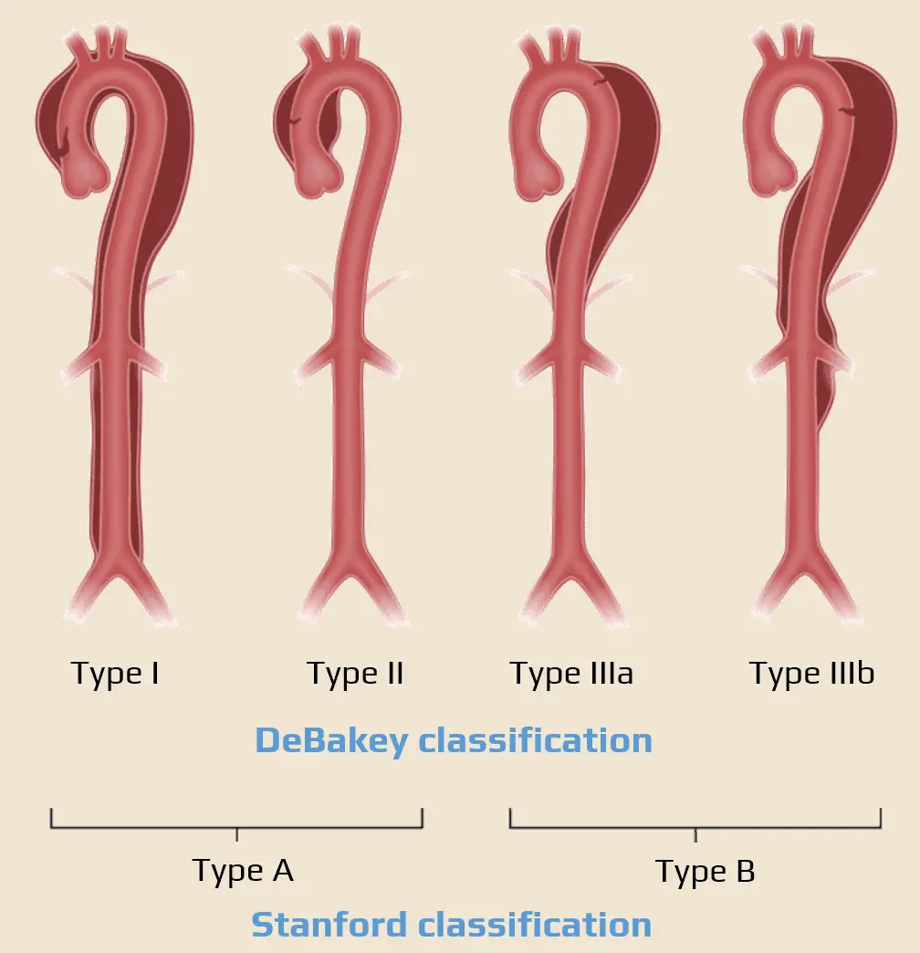 Aortic-dissection-classification