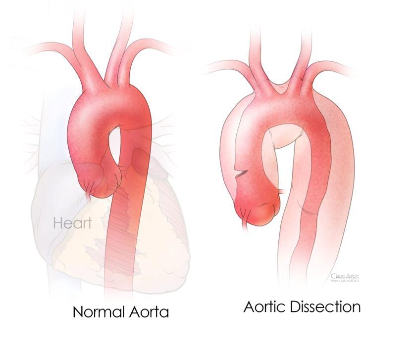 aortic-dissection2