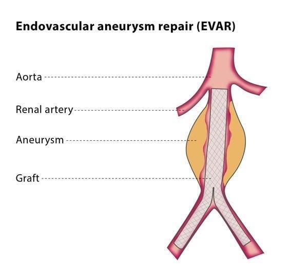 EVAR600x531-600x531