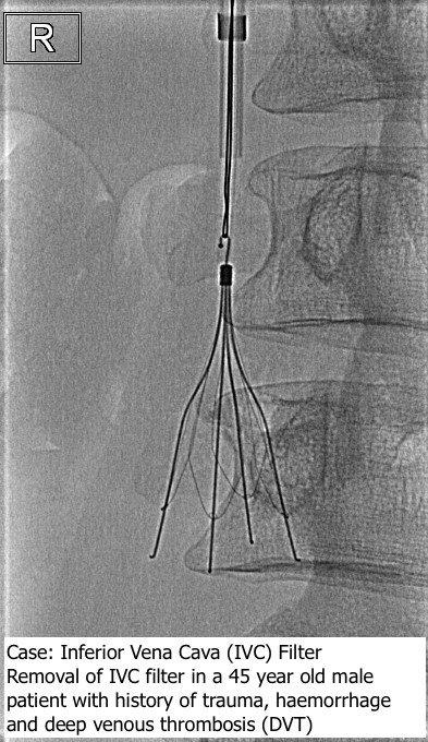 Inferior-Vena-Cava-IVC-Filter-Annotated