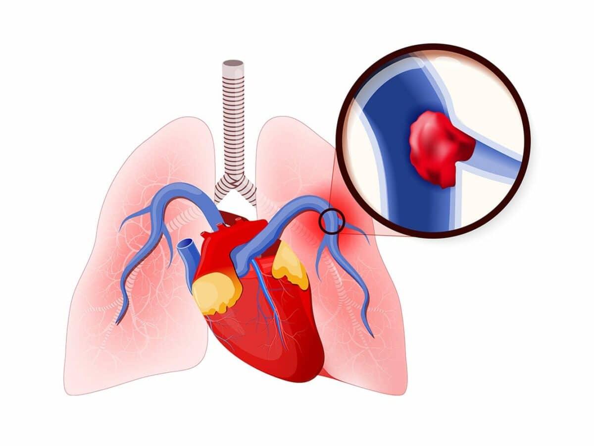 lung-pulmo-embolism-1500-1200x900