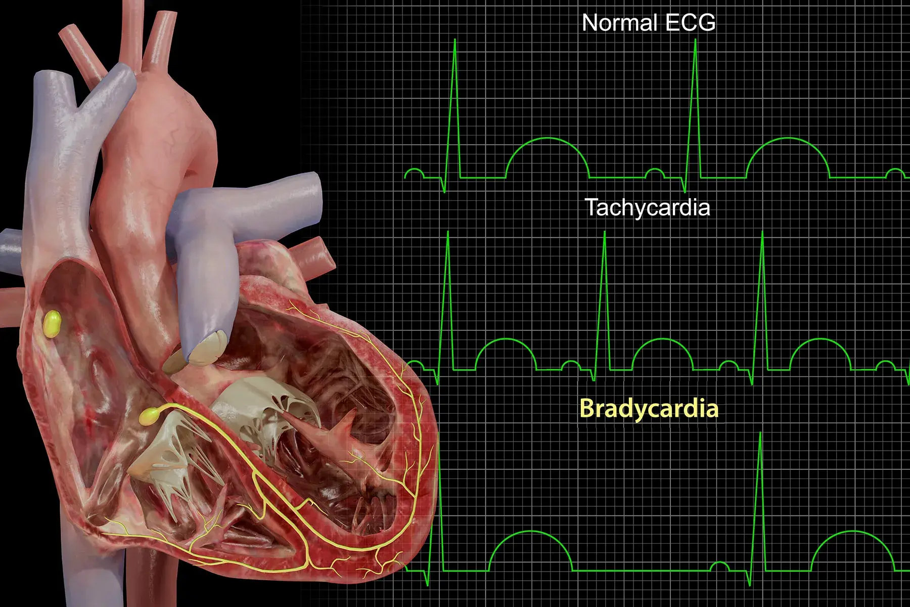 1800x1200_bradycardia_bigbead