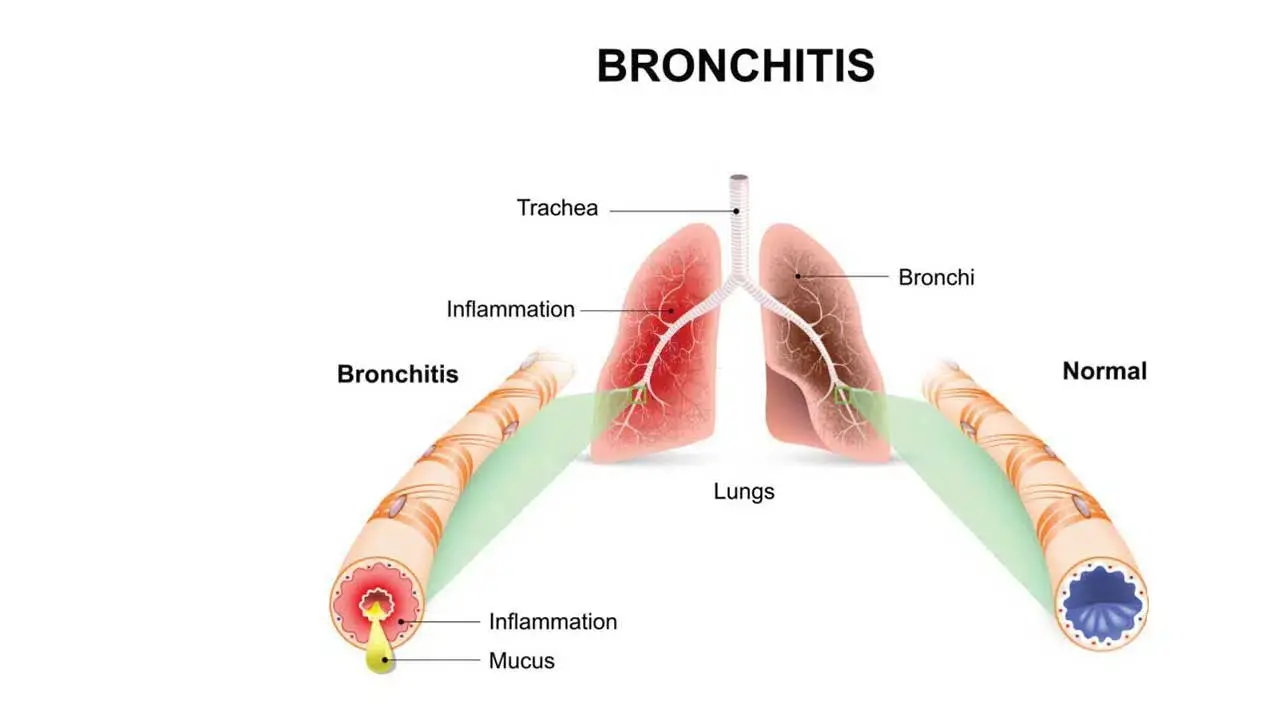 cdn-cdn_bronchitiss-1669624818