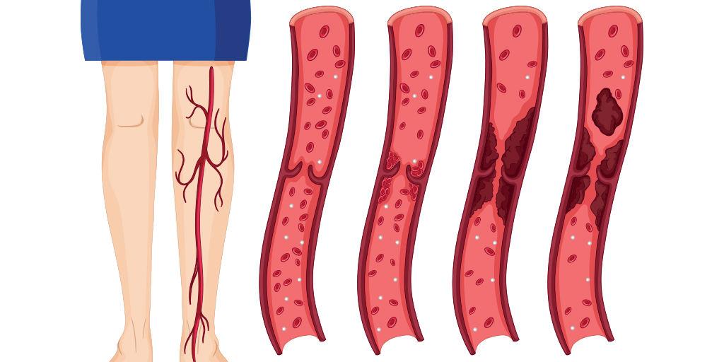 Blood-Clot