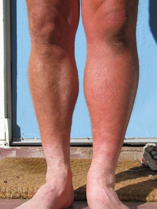 DVT-Deep-Vein-Thrombosis-image