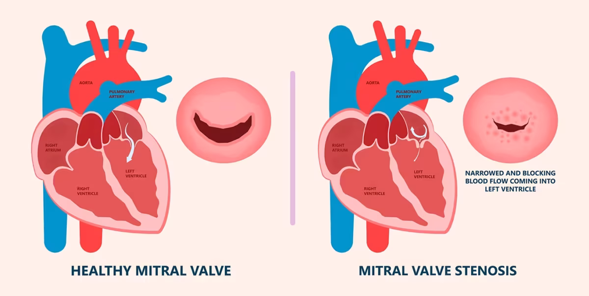 mitral-valve-stenosis-1200x604