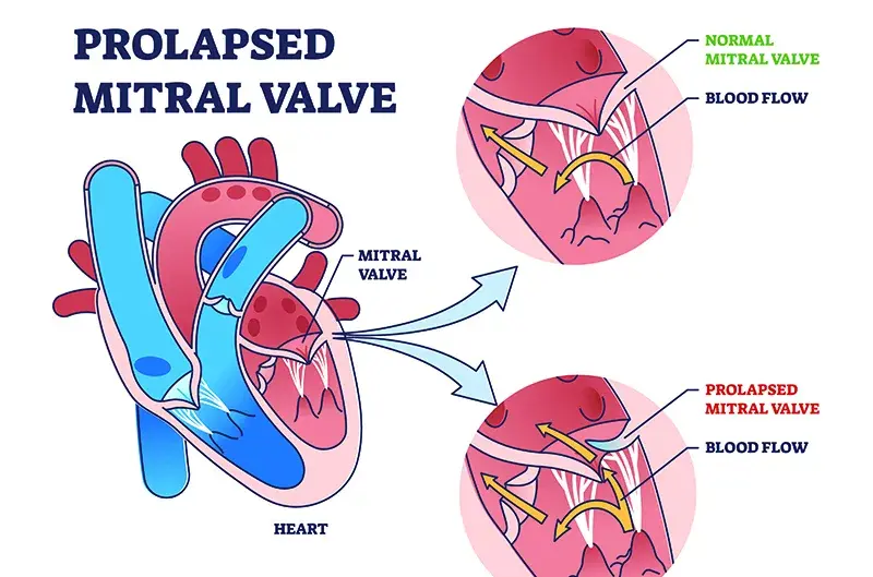 mitral_valve-jpg