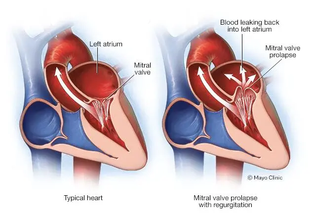 mitral-valve-prolapse-and-regurgitation