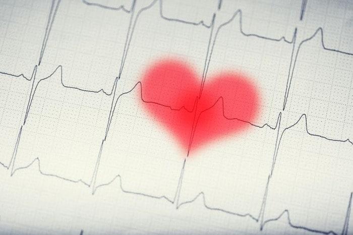 Arrhythmia treatment