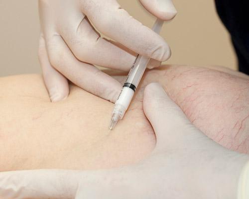 direct-vision-sclerotherapy-feat