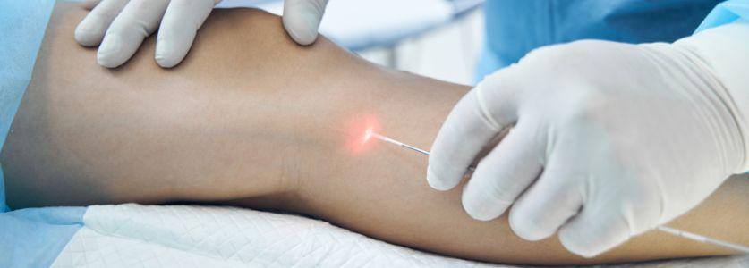 evla-vein-treatment