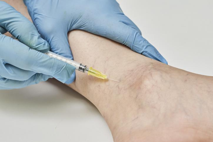 Sclerotherapy-in-ankle