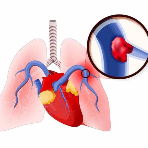 آمبولی ریه (Pulmonary Embolism)