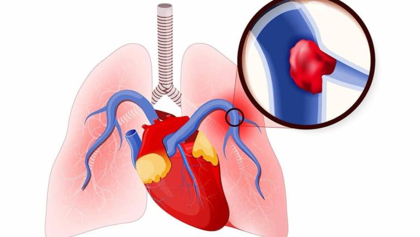 آمبولی ریه (Pulmonary Embolism)