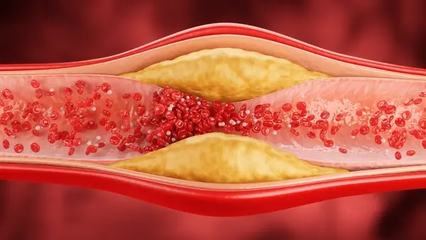 3d-illustration-narrowed-blood-vessel-600nw-2678725569