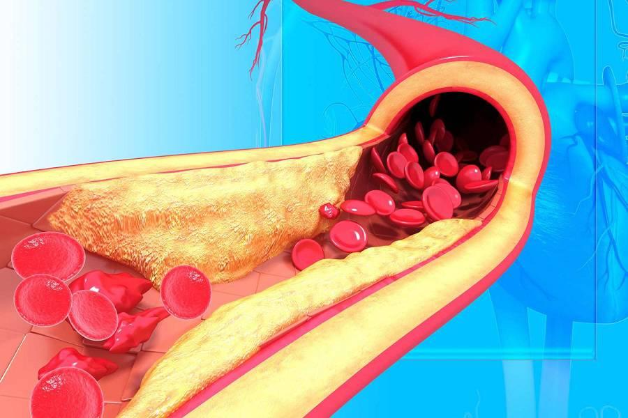 atherosclerosis-56d1d3323df78cfb37c76628