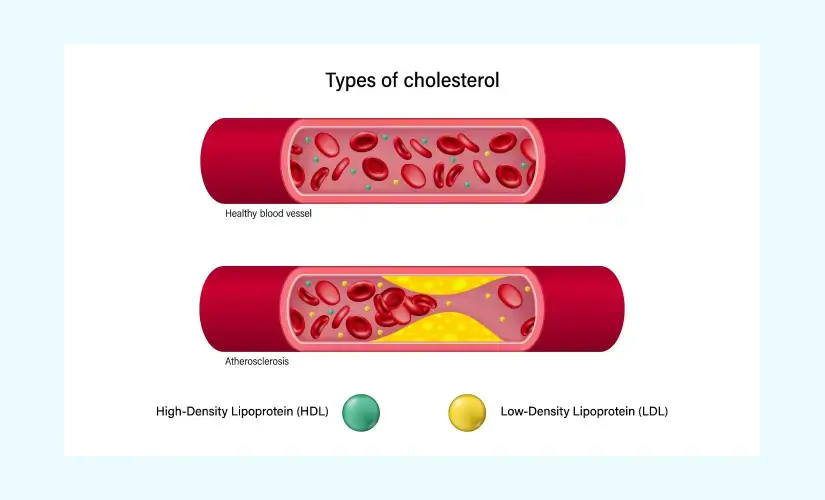 lipid-panel-test