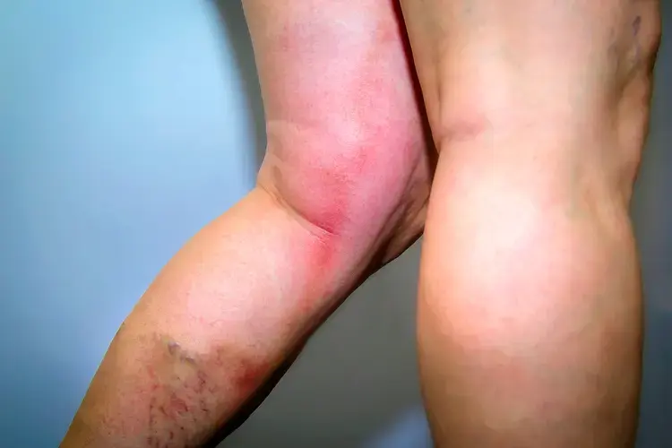 1800ss_getty_deep_vein_thrombosis_in_leg