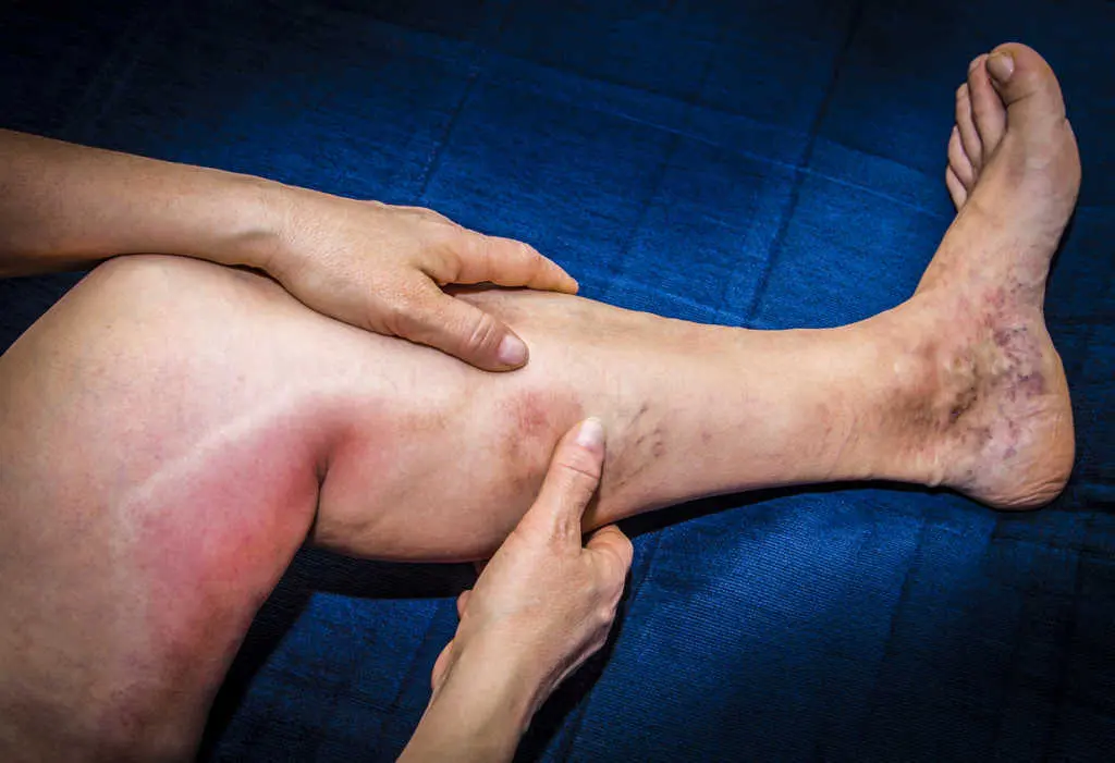 deep-vein-thrombosis