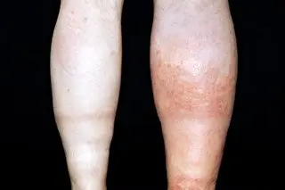 S_0917_deep-vein-thrombosis_C0117382.width-320