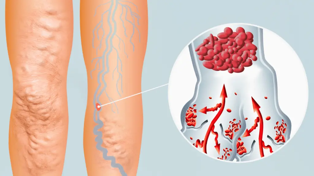 What-is-a-Blood-Clot-1024x576.png