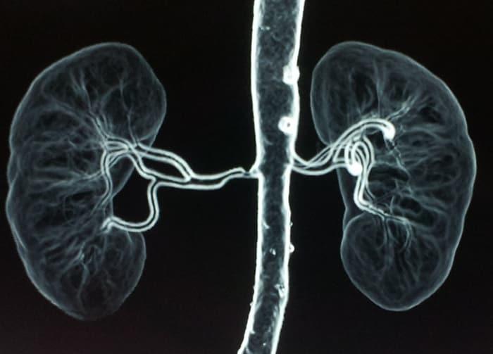 renal-artery-stenosis-angiogram-2-700px