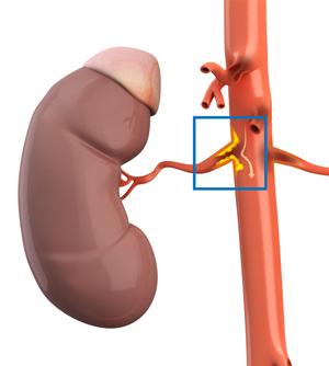 renal-artery-stenosis