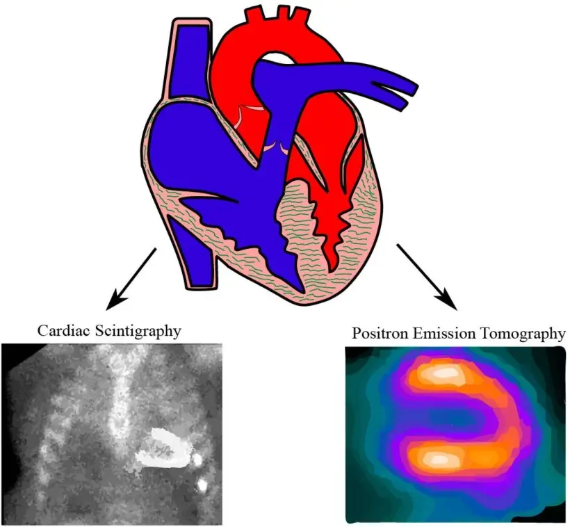 image-01-cardiac-amyloidosis