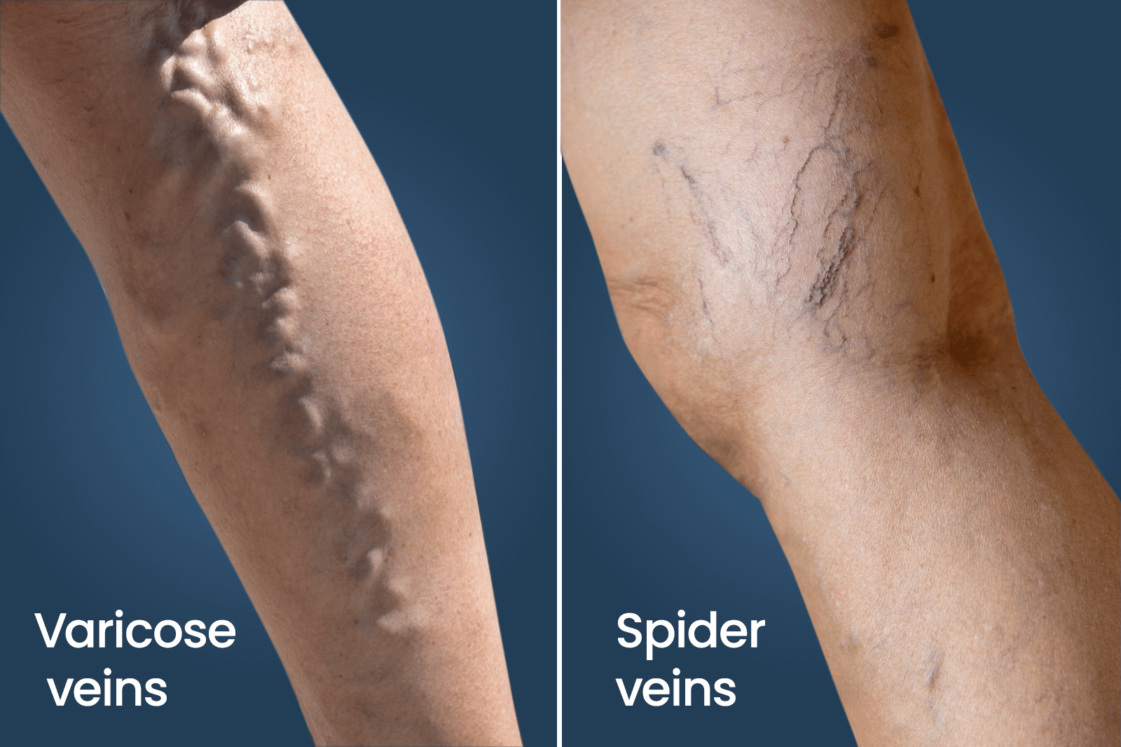 652f7df61a55fe4e6b2f23e2_64e85a28df320ae7007322cd_Varicose20vs20veins