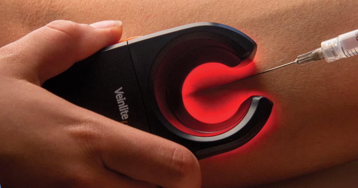 علاج الدوالي بالتصليب (Sclerotherapy)