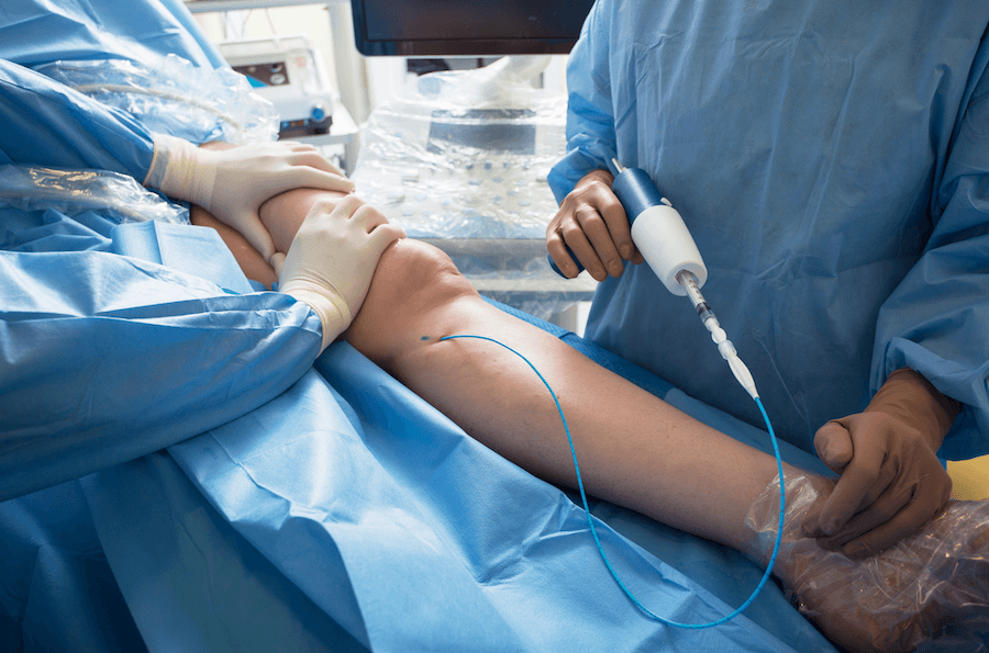 vein-ablation