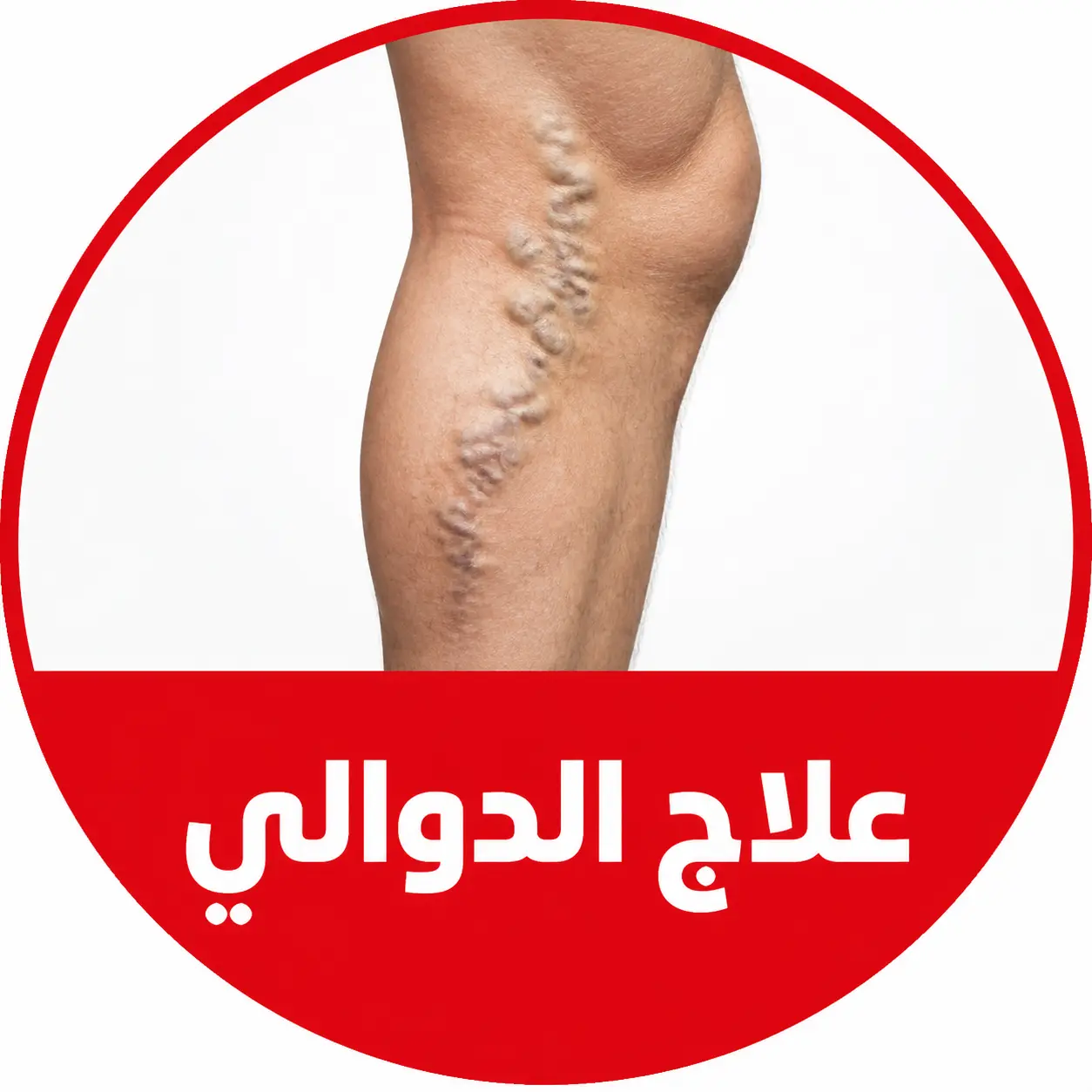علاج دوالي