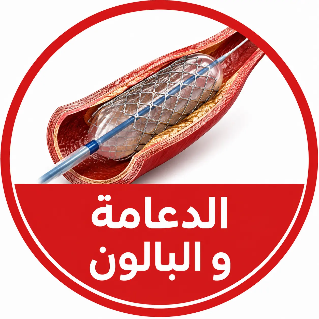الدعامة والبالون
